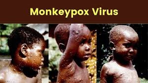 Monkeypox